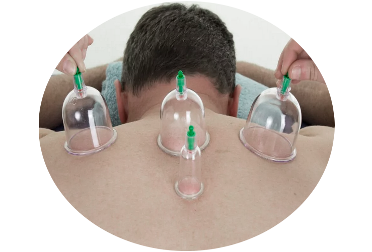 Cupping therapy