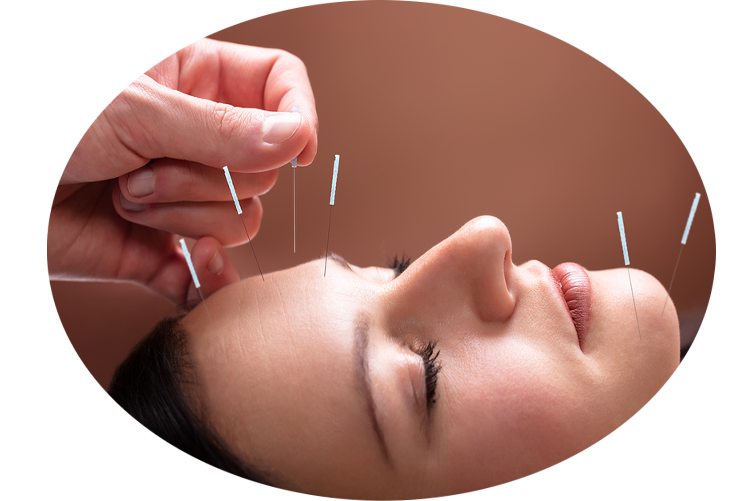 Dry needling